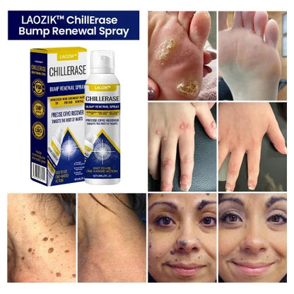 LAOZIKÂ® ChillErase Bump Remover (Massay & Mouke Remover)